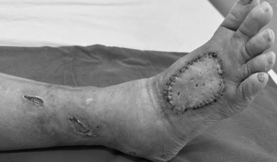 Cứu bàn chân bên bờ cắt cụt cho bệnh nhân đái tháo đường 20 năm