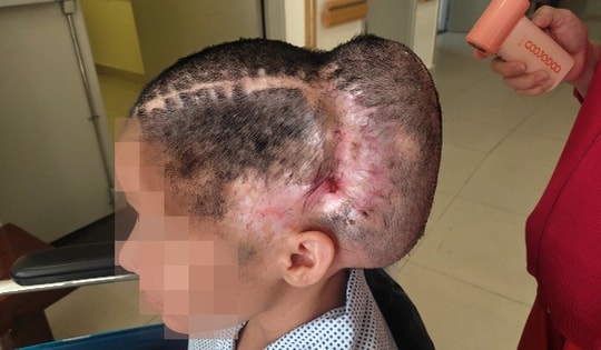 Đột quỵ sau cấy mỡ tự thân, nữ bệnh nhân phải tái tạo hộp sọ