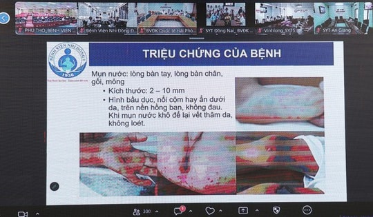 Siết chặt điều trị tay chân miệng: Nâng năng lực hồi sức, đảm bảo cách ly, chuyển tuyến an toàn
