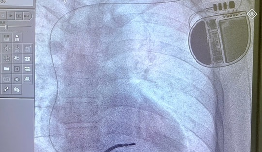 Người đàn ông 3 lần ngất, 1 lần ngưng tim, nguy cơ đột tử cao được cứu nhờ kỹ thuật lần đầu triển khai