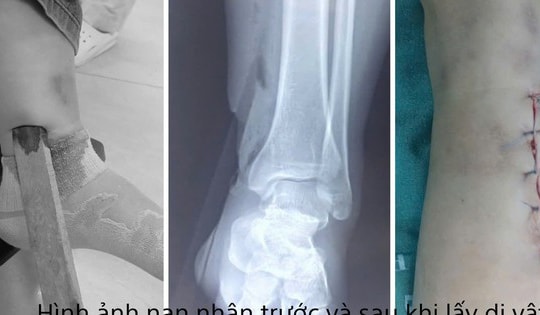 Một phụ nữ bị dị vật cắm sâu vào cẳng chân sau tai nạn giao thông