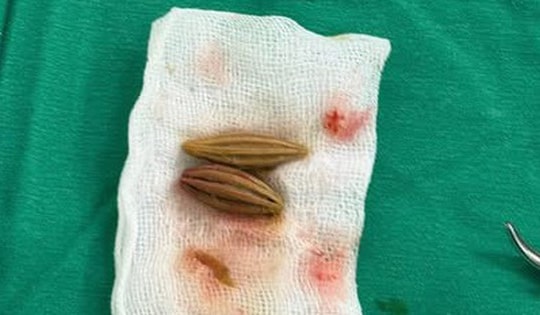 Cụ bà cao tuổi thủng trực tràng vì nuốt hạt nhót