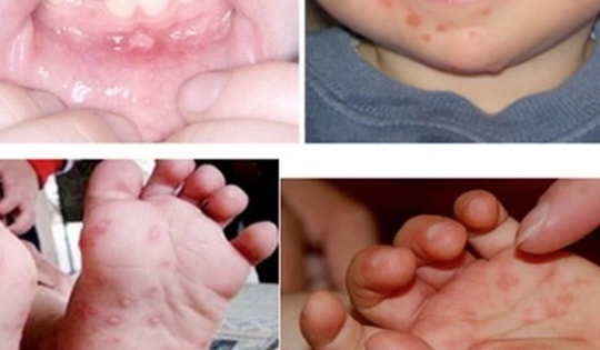 95% ca bệnh tay chân miệng là nhóm trẻ dưới 5 tuổi, Lâm Đồng khẩn trương triển khai ‘3 sạch’ trong trường học