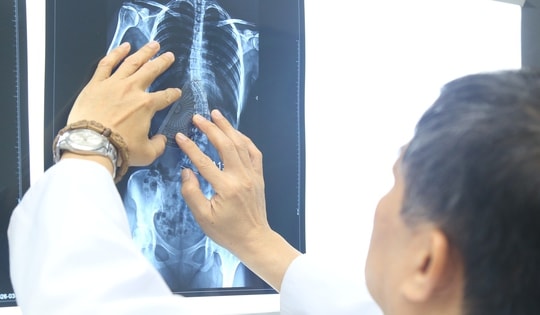 Nhiều trẻ chỉ được phát hiện bệnh khi cột sống đã cong vẹo, chuyên gia khuyến cáo gì đến phụ huynh?