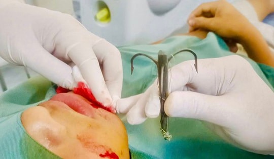 Đi câu cá, lưỡi câu móc vào má