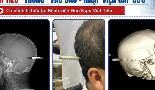 Người đàn ông bị phi tiêu cắm trúng đầu nhập viện khẩn cấp