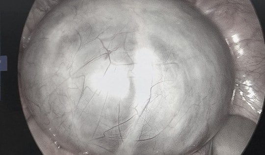 Chủ quan với cơn đau bụng, phát hiện u buồng trứng 14cm