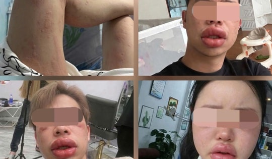 Sưng mắt, môi sau khi ăn bánh trứng kiến: Đặc sản hay 'thủ phạm'?