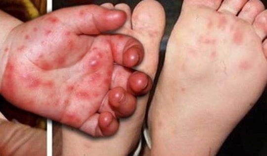 Tay chân miệng ở Khánh Hòa tăng gấp 4 lần năm ngoái, bác sĩ khuyến cáo điều phụ huynh cần làm ngay