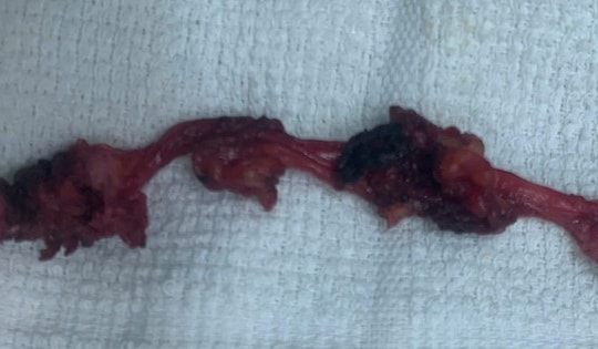 Đau âm ỉ vùng bụng, phát hiện bệnh hiếm nằm sát bàng quang