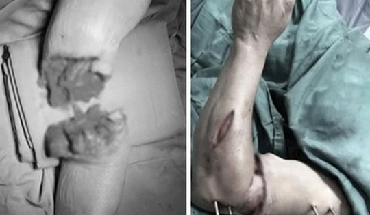 Hồi sinh cánh tay đứt lìa dập nát trong 'giờ vàng'