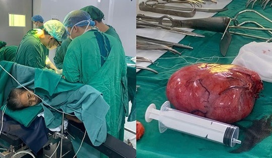 Phẫu thuật thành công khối u sau phúc mạc khổng lồ nằm ở vị trí phức tạp