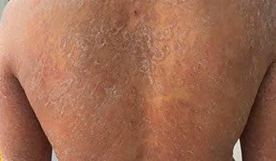 Dùng sai thuốc, nấm da lan toàn thân, ngứa dữ dội