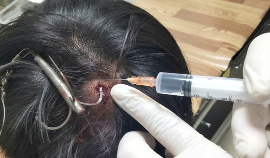 Móc câu 3 tiêu cắm sâu vào đỉnh đầu thiếu niên