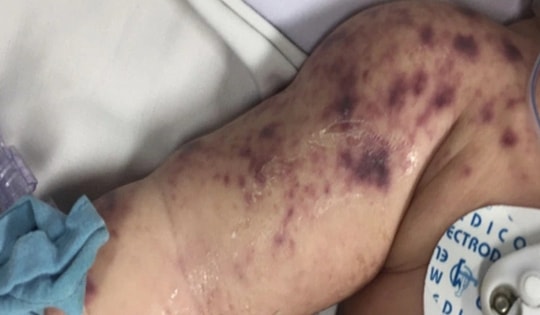 Đã có 4 ca tử vong do não mô cầu, cần biết 4 khuyến cáo phòng bệnh của Bộ Y tế