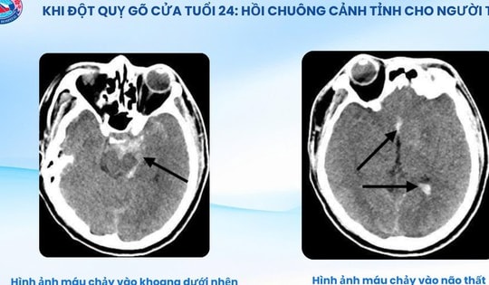Bệnh viện Hữu nghị Việt Tiệp cứu sống bệnh nhân 24 tuổi bị đột quỵ