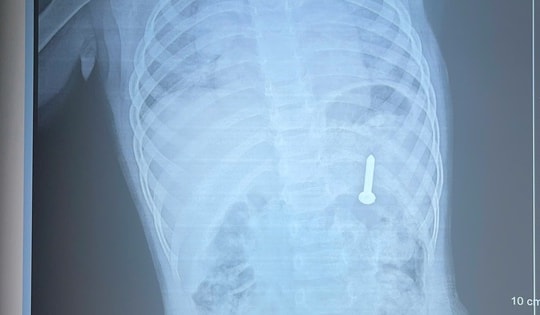 Bé 21 tháng tuổi nuốt phải đinh vít dài khoảng 2,5cm