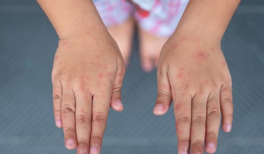 Các cấp độ bệnh tay chân miệng và dấu hiệu cảnh báo