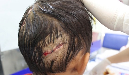 Bé 4 tuổi bị chó nhà cắn, nhiều vết thương nặng ở đầu và tay