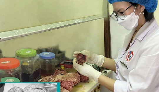 Người phụ nữ 46 tuổi mang trong mình khối u tử cung khổng lồ nặng 5kg