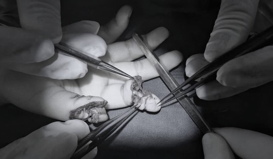 Bé 5 tuổi đứt rời 2 ngón tay khi chơi xe điện tự chế