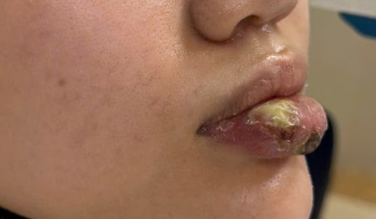 Biến dạng môi sau tiêm 'giải filler' tại spa