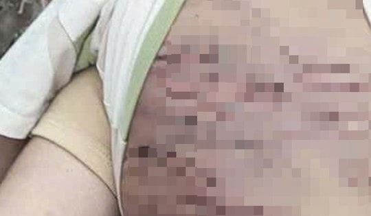 Bộ Y tế vào cuộc vụ bé trai 2 tuổi bị bạo hành dã man ở TP Hồ Chí Minh