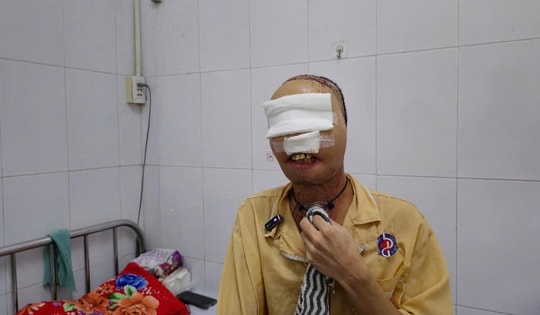 Hành trình 'làm lại gương mặt' cho chàng thanh niên mang di chứng bỏng suốt 3 năm