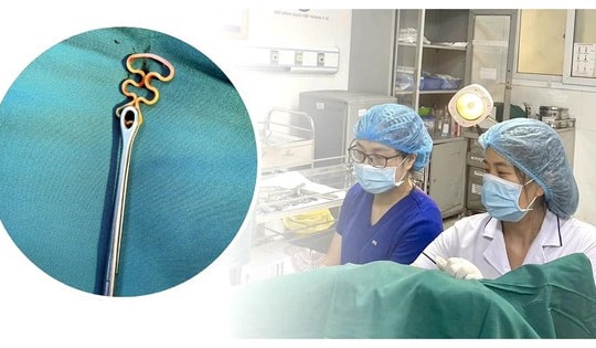 Bỏ quên vòng tránh thai suốt 30 năm, người phụ nữ 63 tuổi gặp biến chứng phụ khoa

