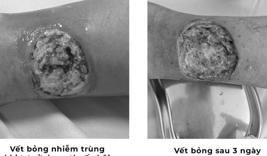 Tự chữa bỏng bằng thuốc dân gian, người đàn ông suýt hoại tử chân