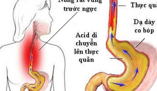 Hệ lụy khi dùng nhiều thuốc giảm tiết acid ở người trào ngược dạ dày - thực quản