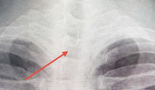 Sau ăn cá người đàn ông 46 tuổi bị mắc lưỡi câu sâu trong thực quản