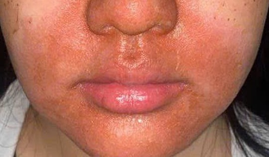 Peel da mặt làm đẹp, cô gái mọc chi chít mụn nước, vỡ chảy dịch