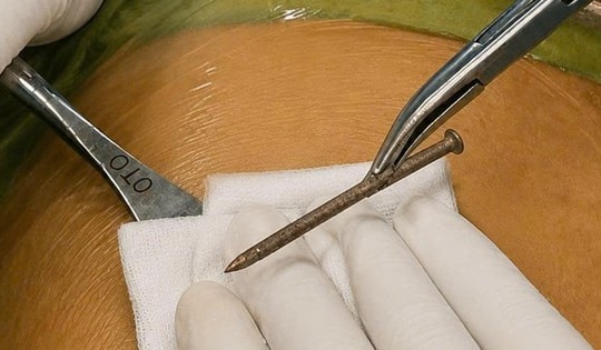 Đinh bắn xuyên bụng khi sửa đồ tại nhà