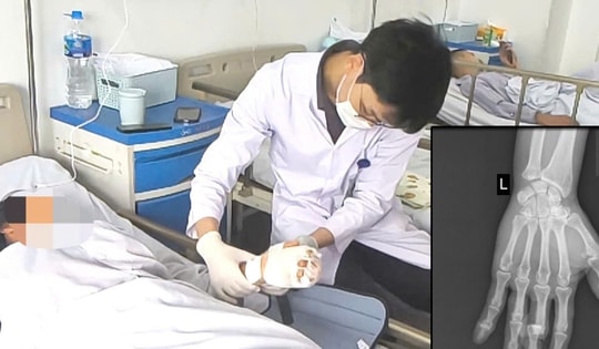 Vi phẫu cứu ngón tay đứt lìa cho nữ công nhân phụ hồ bị máy trộn bê tông cuốn nát bàn tay