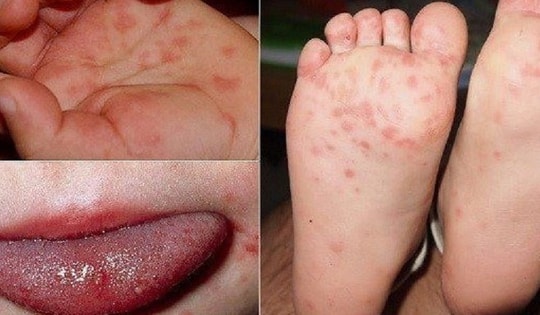 Khánh Hòa đã ghi nhận 2.254 ca tay chân miệng, bác sĩ khuyến cáo điều cần nhớ để phòng bệnh