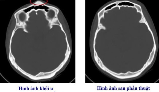 Bệnh viện Việt Nam - Thụy Điển Uông Bí phẫu thuật thành công ca u xương sọ hiếm gặp