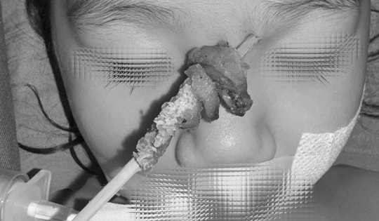 Tai nạn hy hữu: Bé gái 2,5 tuổi bị que xiên thịt đâm sâu, nguy cơ xuyên sọ não