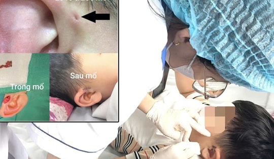Hi hữu ca rò luân nhĩ di truyền qua 3 thế hệ