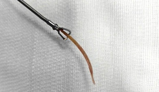 Người đàn ông bị tăm tre đâm thủng đại tràng