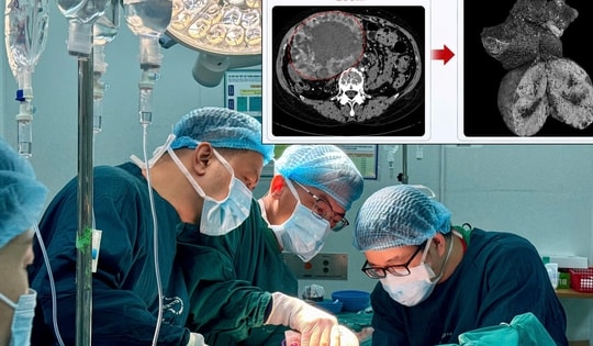 U gan 2 cm 'phình' lên 20 cm do tự điều trị bằng thuốc nam