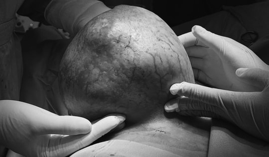 Ngại không đi khám sớm, người bệnh chịu đựng khối u vú nặng gần 4kg
