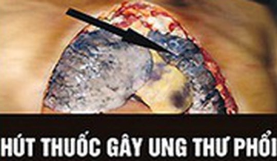 WHO: Cảnh báo trên bao bì thuốc lá là cách truyền thông hiệu quả, ít tốn kém