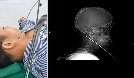 Nam thanh niên đi bắn cá bị mũi tên bật ngược đâm xuyên sâu 15cm vào vùng mặt