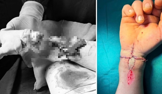 Nối thành công bàn tay bị đứt rời cho người phụ nữ bị tai nạn do máy cưa