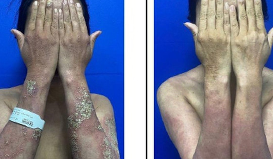 Người phụ nữ mắc vảy nến chi chít mụn mủ, kháng phác đồ điều trị truyền thống