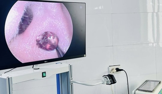 Đau nhức tai suốt một tuần, người phụ nữ tá hỏa vì 'vị khách lạ' trong tai