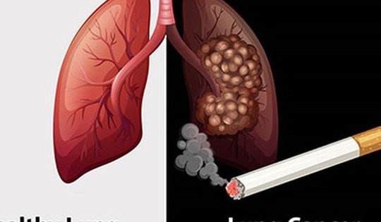 Thuốc lá gây ra 90% các trường hợp ung thư phổi
