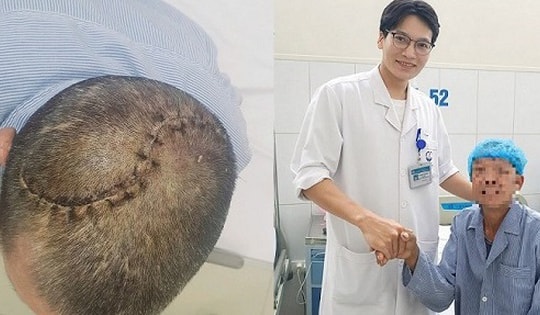 90 phút 'nghẹt thở' cứu người đàn ông bị vỡ lún sọ, tràn máu màng phổi