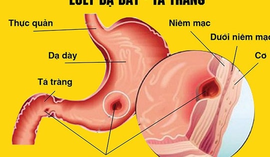 Những nguy cơ khi tự ý dùng meloxicam trị đau xương khớp